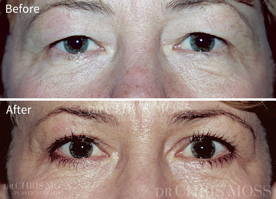 upper blepharoplasty before after