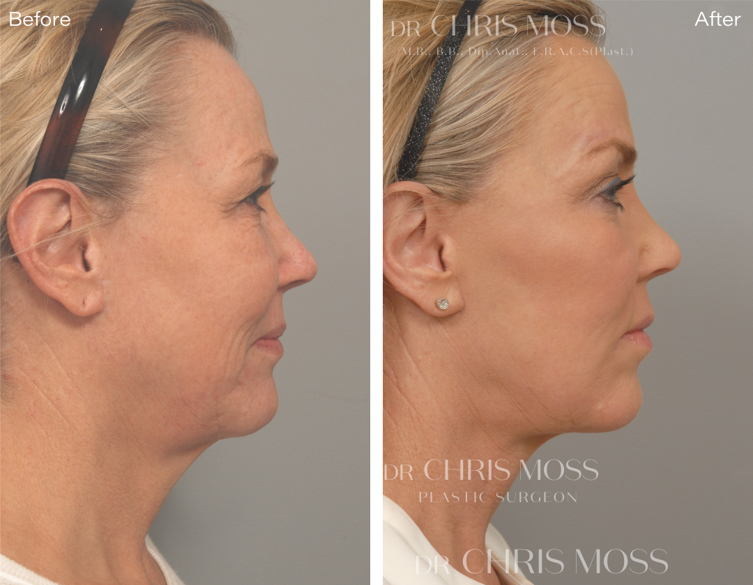 What is the importance of compression after facelift surgery?